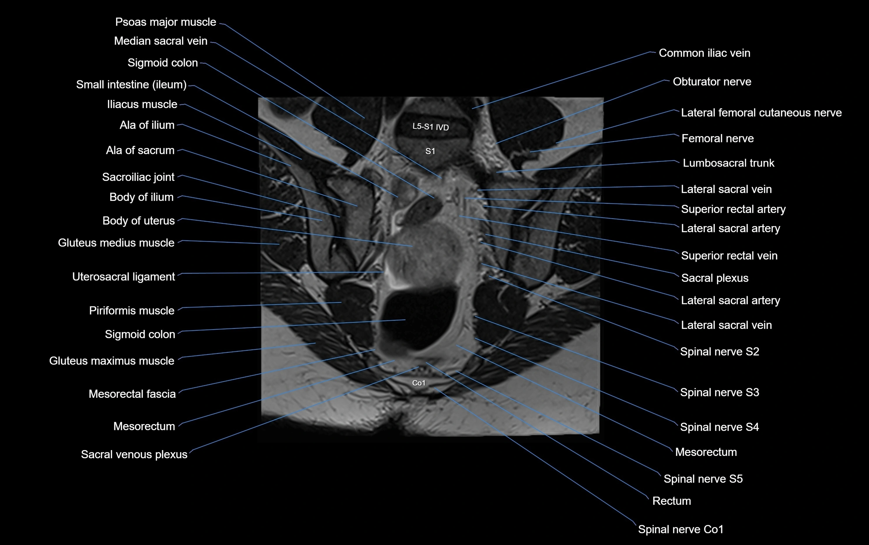 MRI sacroiliac joint coronal cross sectional anatomy  radiology  image-img-00001-00013.webp